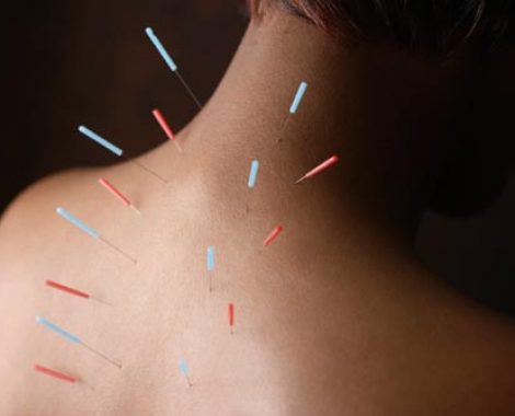 corbis_rf_photo_of_acupuncture_needles_in_womans_back